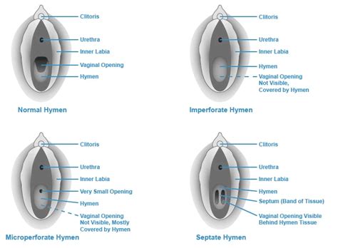 hymen photo|What Is the Hymen: Anatomy, Functions, Types and Care